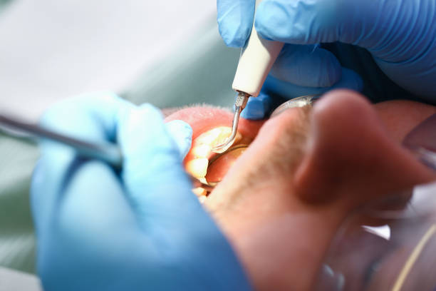 Best Emergency Root Canal Treatment in Stepney, CT